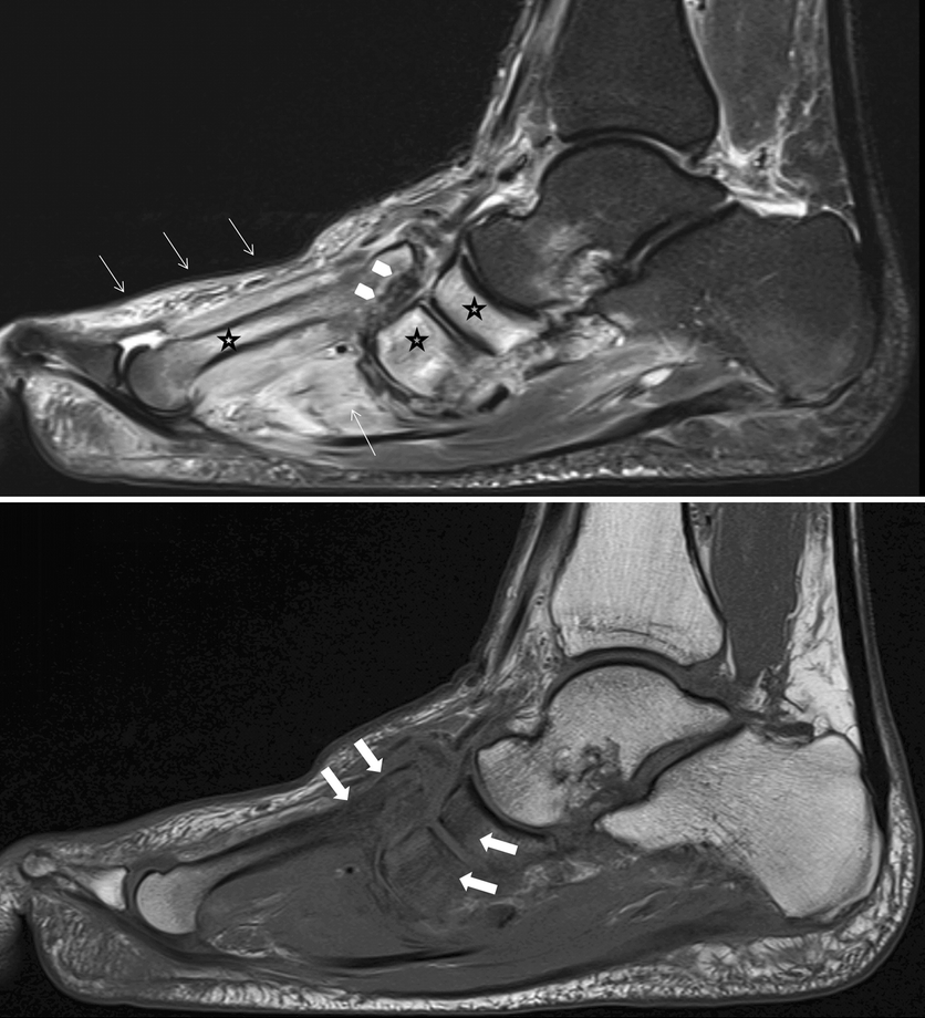 диабетическая стопа.png