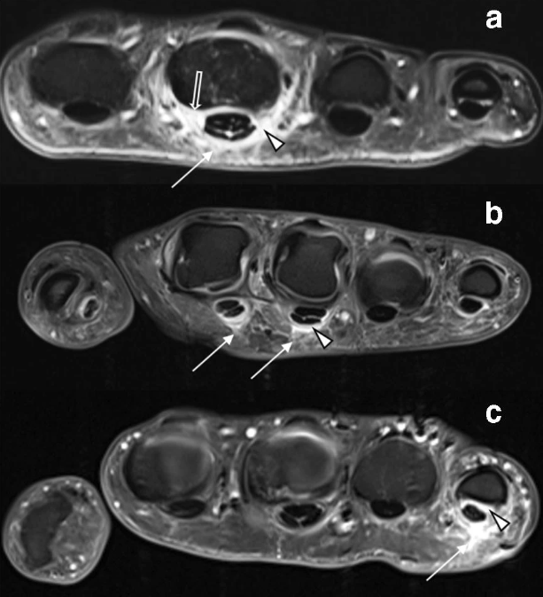 псориатический артрит.png
