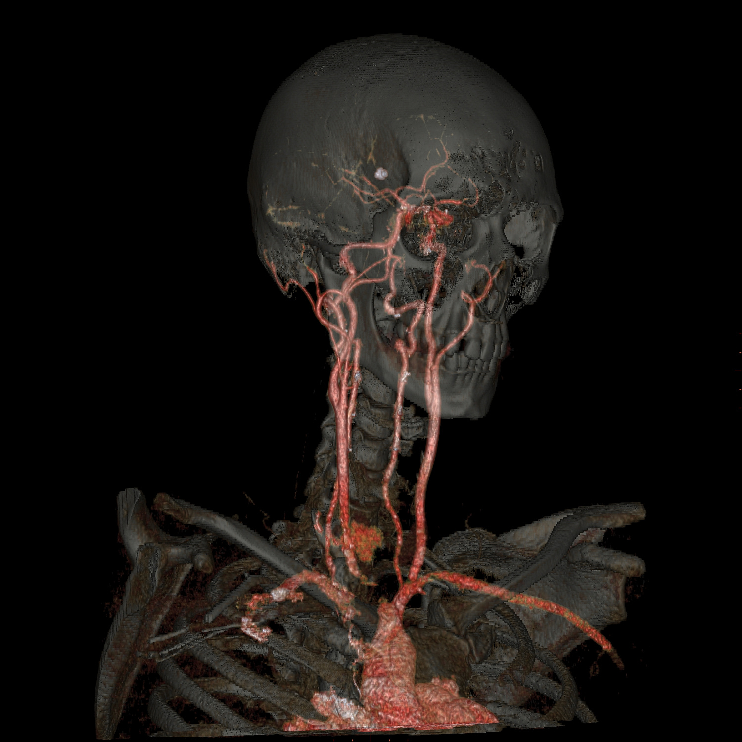 КТ-ангиография артерий головного мозга и шеи