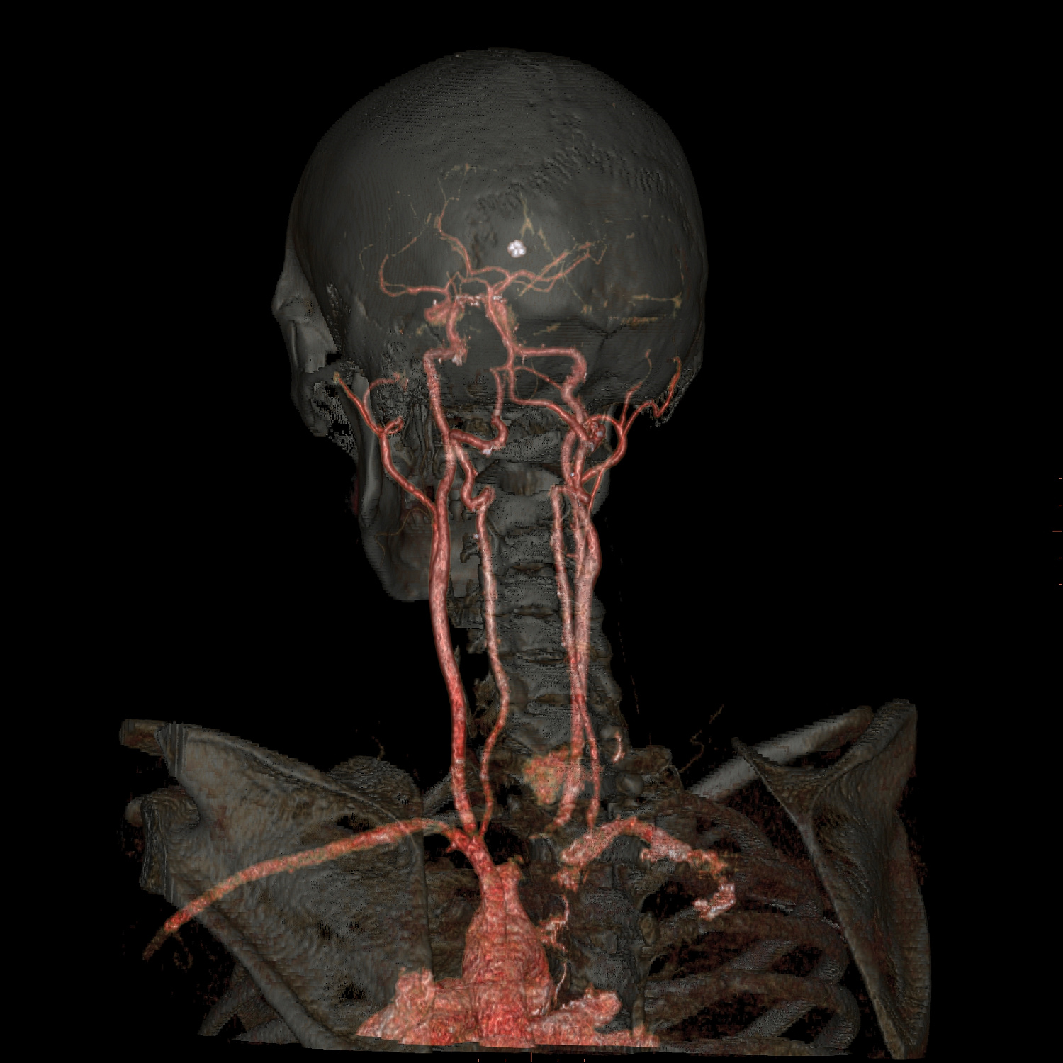 КТ-ангиография артерий головного мозга и шеи